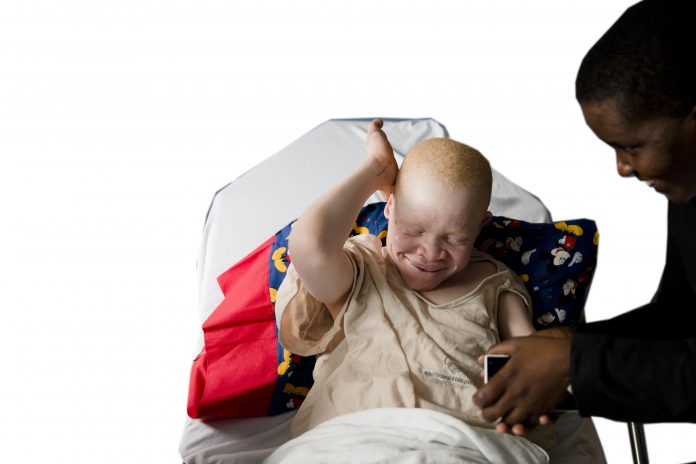 Albino Children Prosthetics
